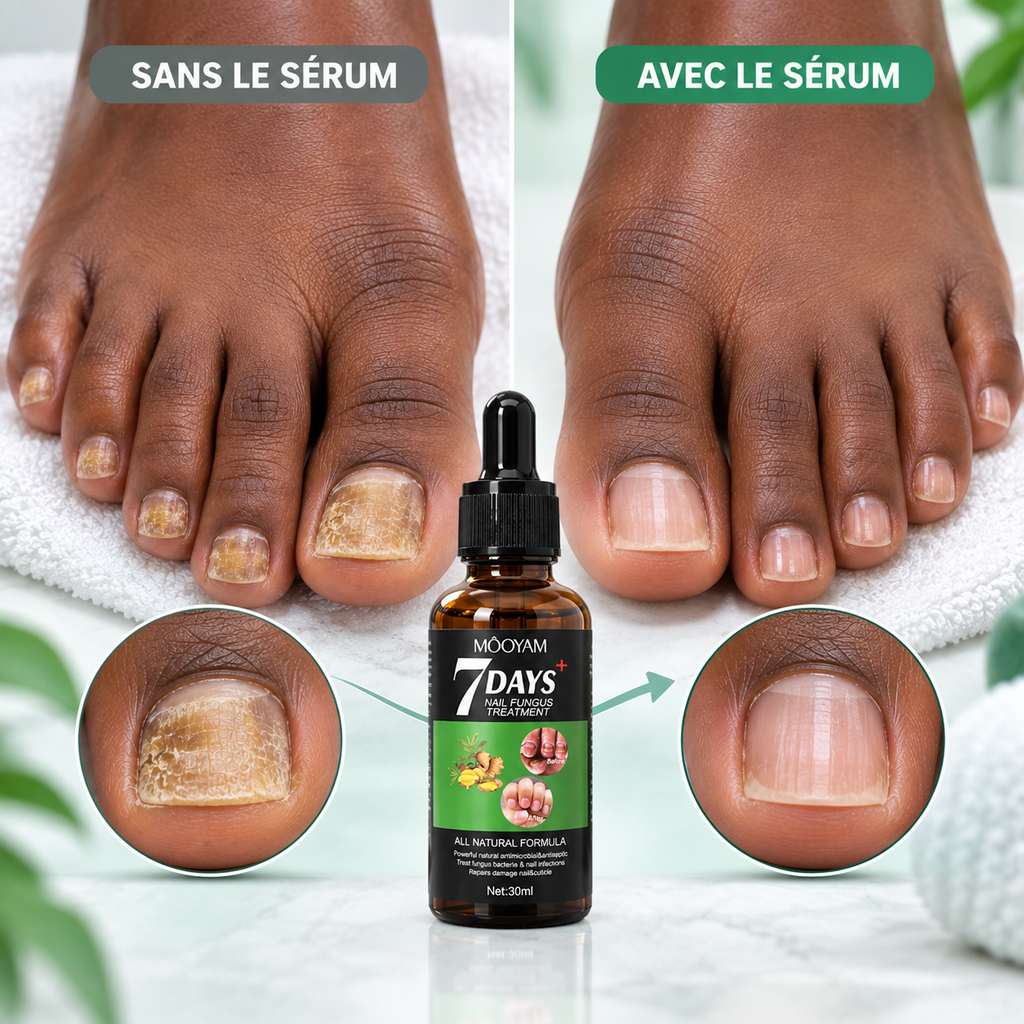 Sérum Réparateur des Ongles Abîmés & Jaunis™ MOOYAM